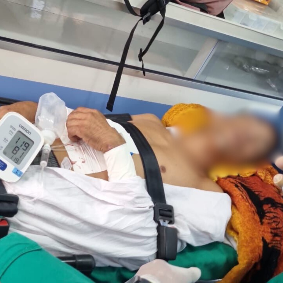 Jovem baleado por PM durante surto perdeu um rim, quebrou costelas e segue intubado em hospital no Acre