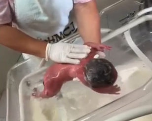 Bebê queimada durante banho em hospital no Acre segue sem avaliação de especialista e pai se revolta