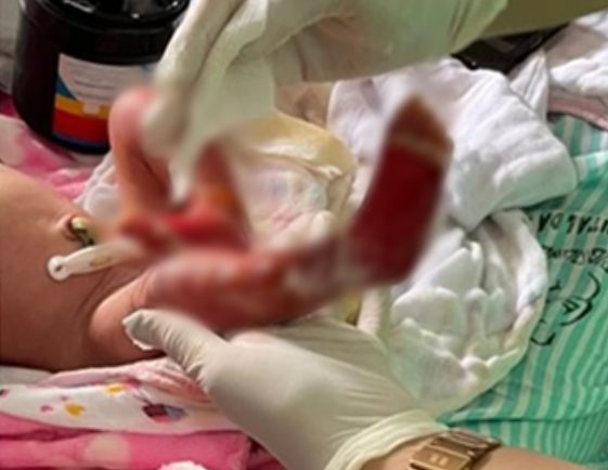 Boas notícias: bebê Aurora apresenta melhora significativa e já respira sem ajuda de aparelhos
