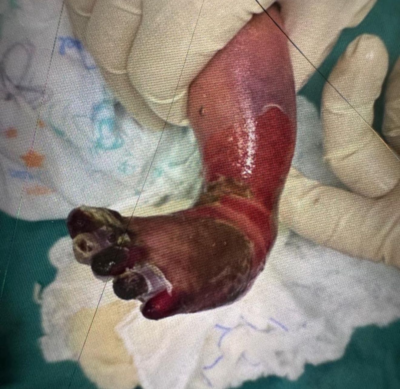Imagem de bebê queimada com água quente em hospital do Acre choca e revolta a população