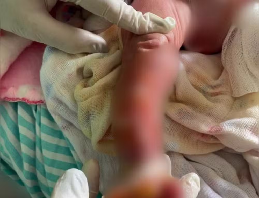 Bebê internada após banho quente em hospital será transferida para centro de queimados em Manaus