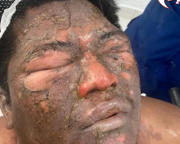 No Acre, explosão de panela de pressão deixa homem com queimaduras graves no rosto