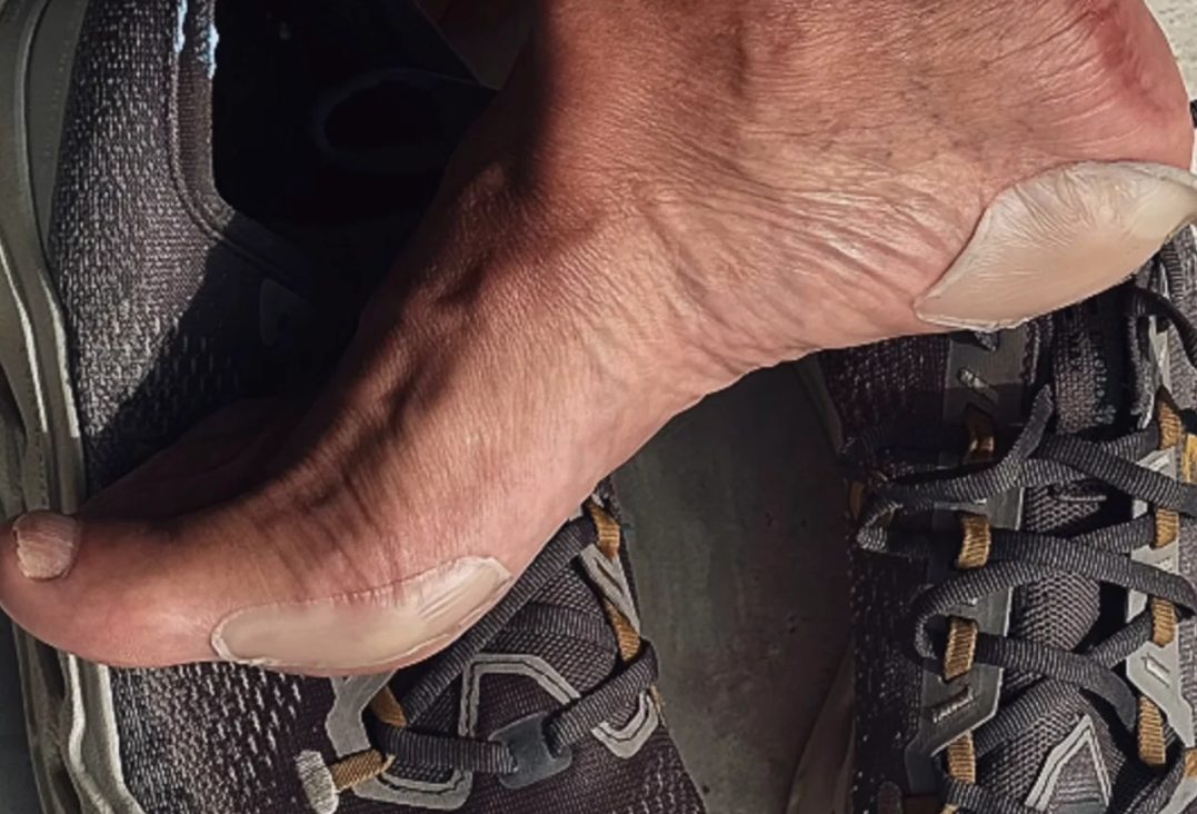 Após andar 200km pela liberdade de Bolsonaro, Márcio Bittar só conseguiu calos nos pés e pele bronzeada