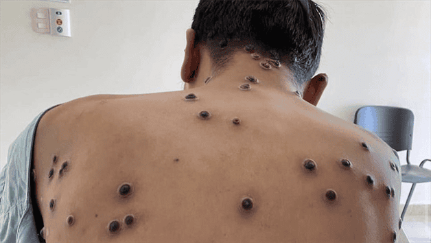 Saiba como se proteger da MPOX; Brasil já registrou 57 casos neste ano